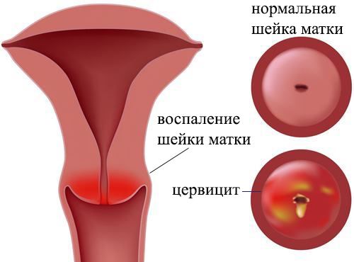 цервицит матки